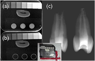 Iodixanol as a Contrast Agent in a Fibrin Hydrogel for Endodontic Applications